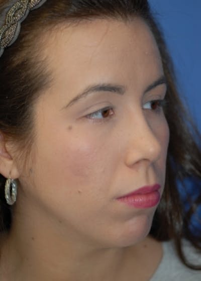 Rhinoplasty Before & After Gallery - Patient 5883944 - Image 4