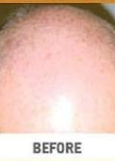 Hair Transplant Before & After Gallery - Patient 5883945 - Image 1