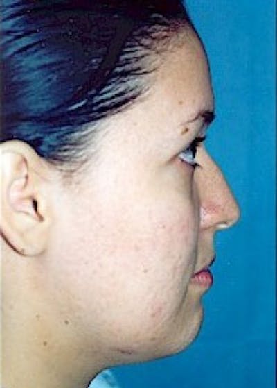 Rhinoplasty Before & After Gallery - Patient 5883947 - Image 1