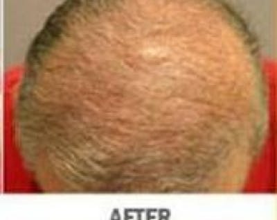 Hair Transplant Before & After Gallery - Patient 5883945 - Image 2