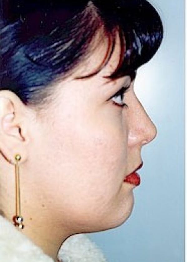 Rhinoplasty Before & After Gallery - Patient 5883947 - Image 2