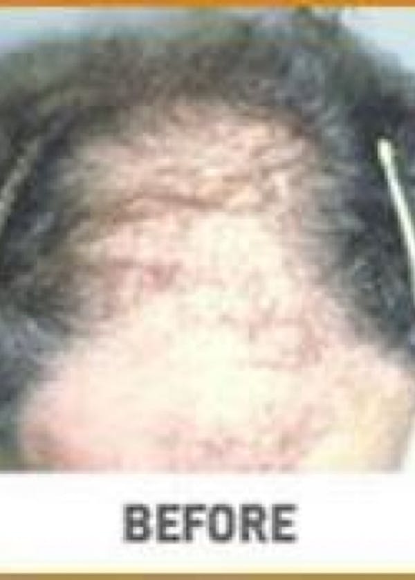 Hair Transplant Before & After Gallery - Patient 5883948 - Image 1