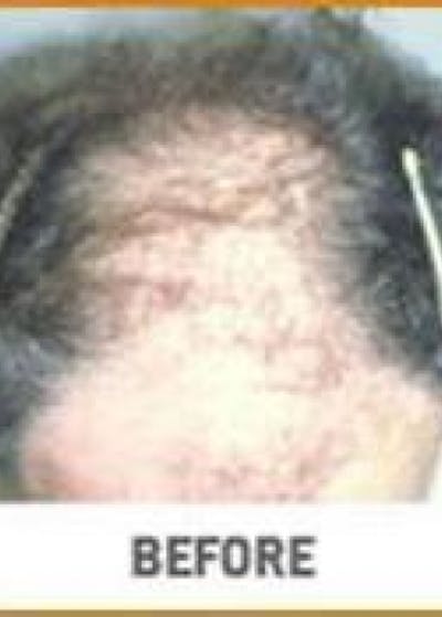 Hair Transplant Before & After Gallery - Patient 5883948 - Image 1