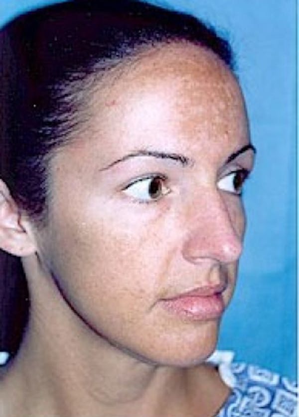 Rhinoplasty Before & After Gallery - Patient 5883949 - Image 1