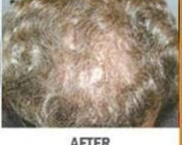 Hair Transplant Gallery - Patient 5883948 - Image 2