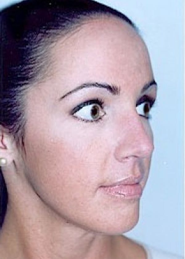 Rhinoplasty Before & After Gallery - Patient 5883949 - Image 2