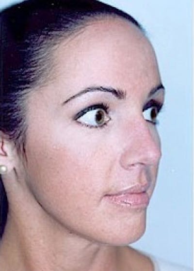 Rhinoplasty Before & After Gallery - Patient 5883949 - Image 2