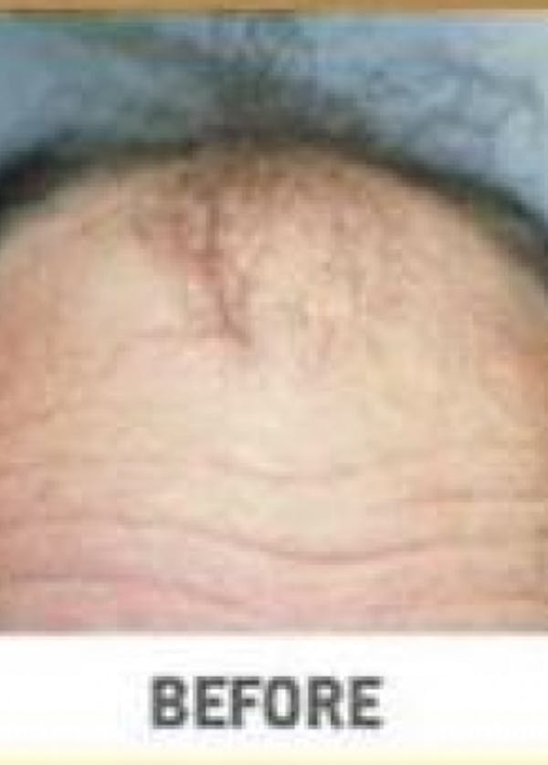 Hair Transplant Before & After Gallery - Patient 5883950 - Image 1