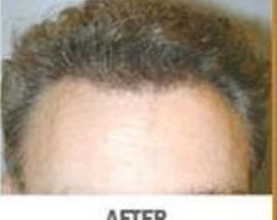 Hair Transplant Before & After Gallery - Patient 5883950 - Image 2