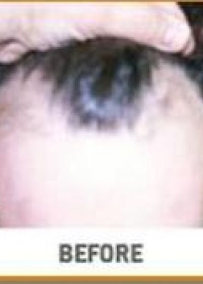 Hair Transplant Before & After Gallery - Patient 5883952 - Image 1