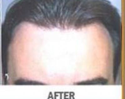 Hair Transplant Before & After Gallery - Patient 5883952 - Image 2