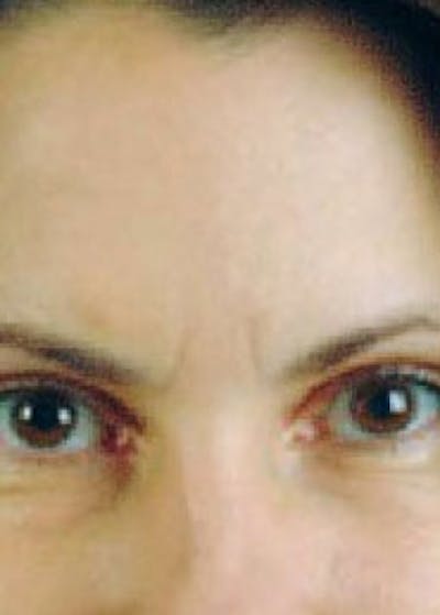BOTOX Before & After Gallery - Patient 5883955 - Image 1