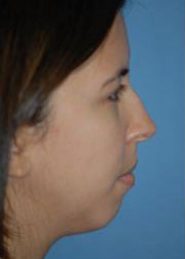 Rhinoplasty Before & After Gallery - Patient 5883957 - Image 1