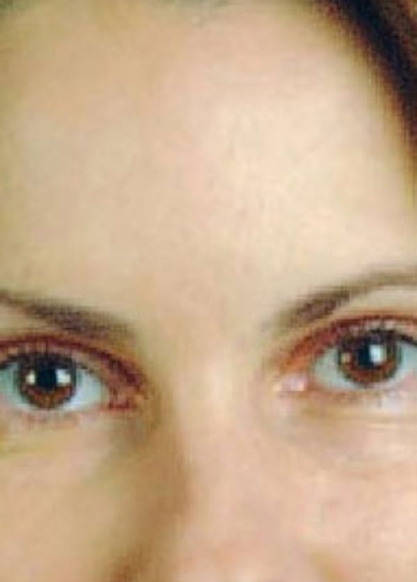 BOTOX Before & After Gallery - Patient 5883955 - Image 2