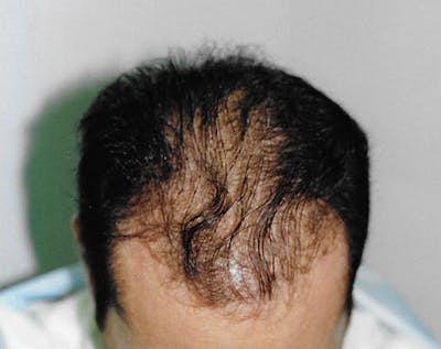 Hair Transplant Before & After Gallery - Patient 5883954 - Image 1