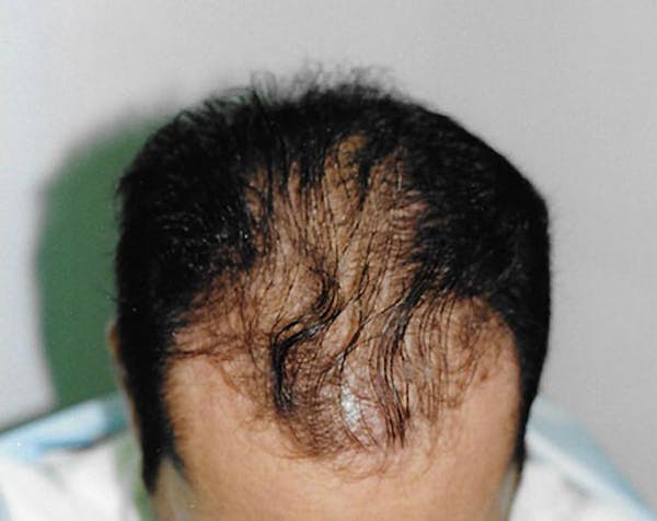 Hair Transplant Gallery - Patient 5883954 - Image 1
