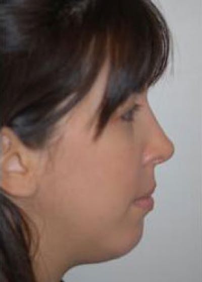 Rhinoplasty Before & After Gallery - Patient 5883957 - Image 2