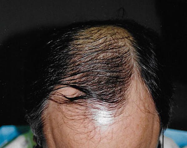 Hair Transplant Before & After Gallery - Patient 5883956 - Image 1