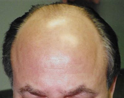 Hair Transplant Before & After Gallery - Patient 5883958 - Image 1
