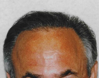 Hair Transplant Before & After Gallery - Patient 5883958 - Image 2