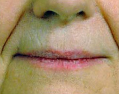 Fillers Before & After Gallery - Patient 5883959 - Image 1