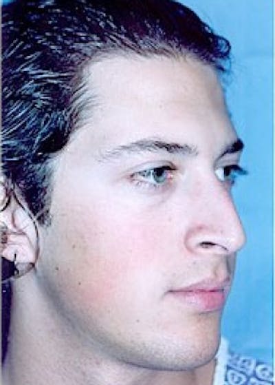 Rhinoplasty Before & After Gallery - Patient 5883960 - Image 1