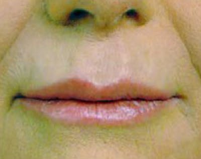 Fillers Before & After Gallery - Patient 5883959 - Image 2