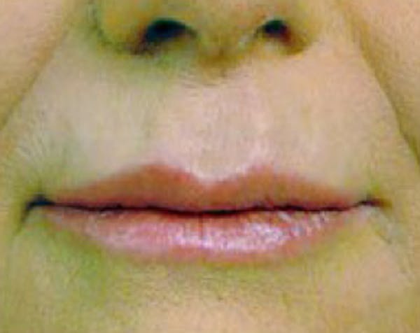Fillers Before & After Gallery - Patient 5883959 - Image 2