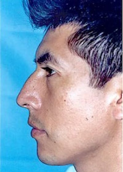 Rhinoplasty Before & After Gallery - Patient 5883961 - Image 1