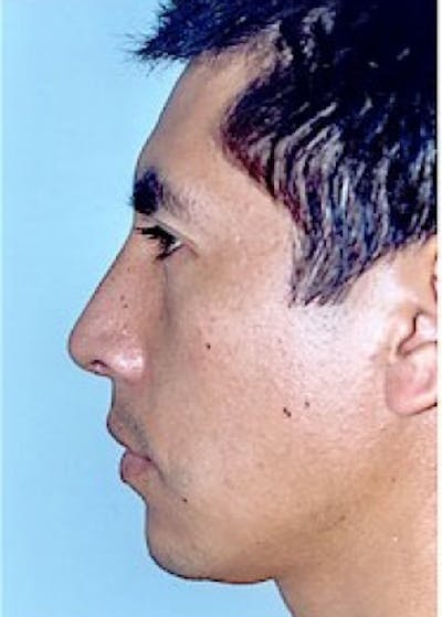 Rhinoplasty Before & After Gallery - Patient 5883961 - Image 2