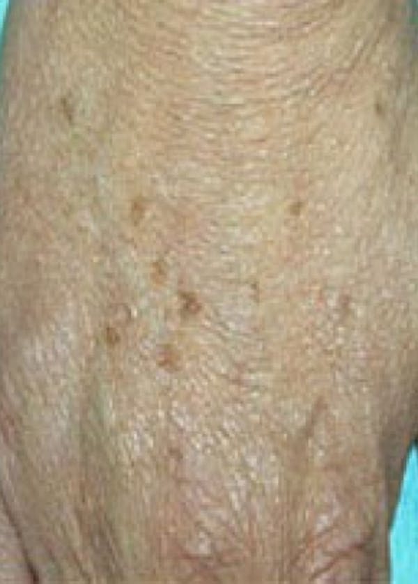 Fraxel Laser Before & After Gallery - Patient 5883962 - Image 1