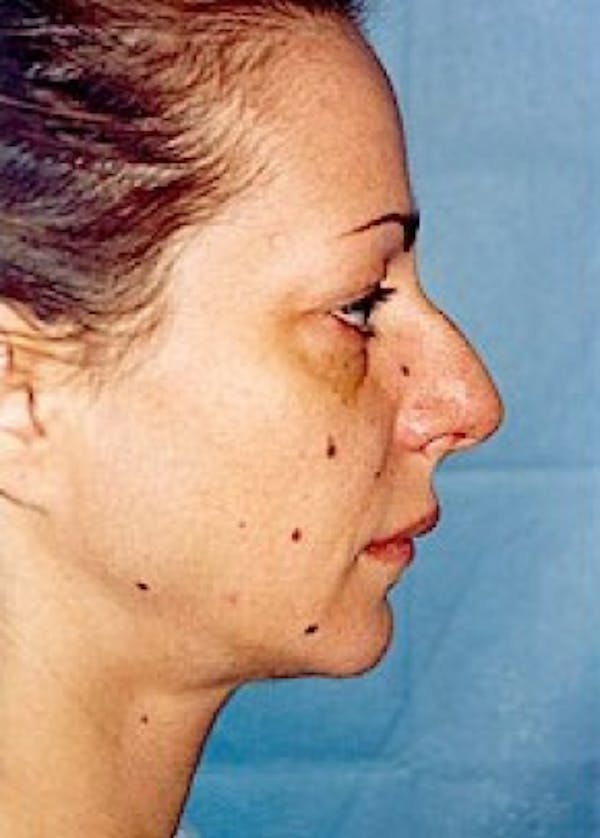 Rhinoplasty Before & After Gallery - Patient 5883963 - Image 1