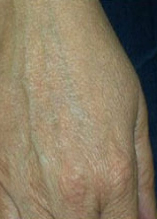 Fraxel Laser Before & After Gallery - Patient 5883962 - Image 2