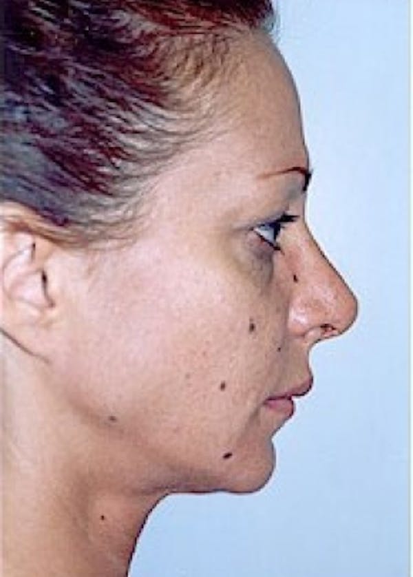 Rhinoplasty Before & After Gallery - Patient 5883963 - Image 2