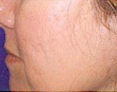Fraxel Laser Before & After Gallery - Patient 5883964 - Image 2
