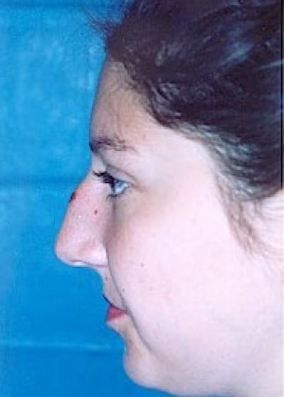 Rhinoplasty Before & After Gallery - Patient 5883967 - Image 1