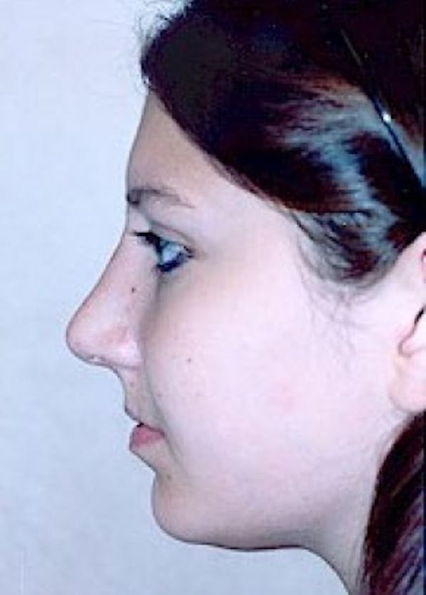 Rhinoplasty Before & After Gallery - Patient 5883967 - Image 2