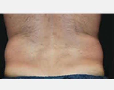 CoolSculpting Before & After Gallery - Patient 5883966 - Image 1