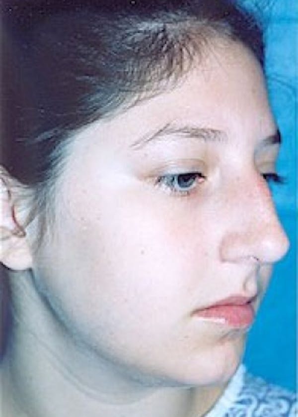 Rhinoplasty Before & After Gallery - Patient 5883967 - Image 3