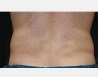CoolSculpting Before & After Gallery - Patient 5883966 - Image 2