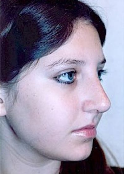 Rhinoplasty Before & After Gallery - Patient 5883967 - Image 4