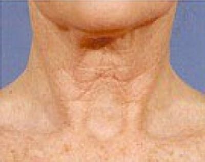 Fraxel Laser Before & After Gallery - Patient 5883969 - Image 1