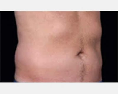 CoolSculpting Before & After Gallery - Patient 5883970 - Image 1