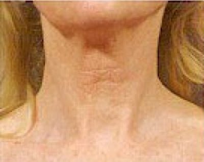 Fraxel Laser Before & After Gallery - Patient 5883969 - Image 2