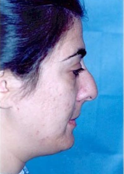 Rhinoplasty Before & After Gallery - Patient 5883975 - Image 1