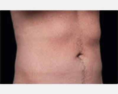 CoolSculpting Gallery - Patient 5883970 - Image 2