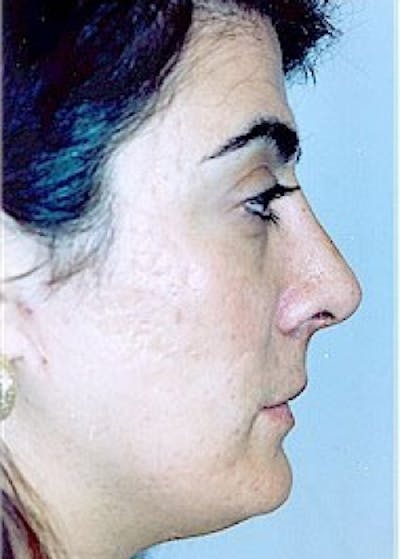 Rhinoplasty Before & After Gallery - Patient 5883975 - Image 2
