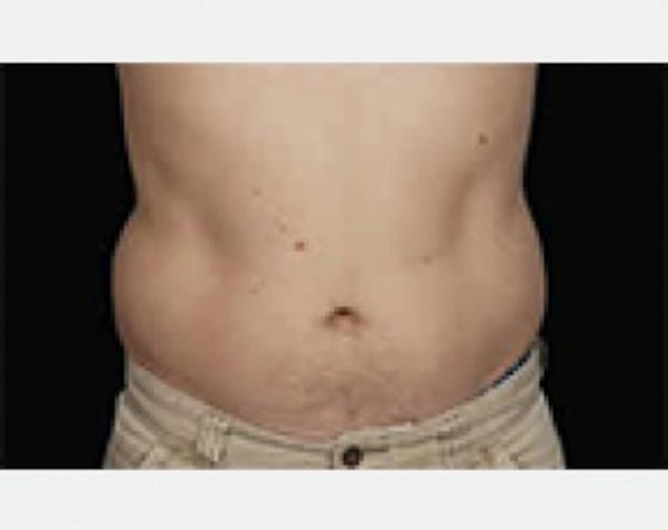 CoolSculpting Before & After Gallery - Patient 5883976 - Image 1