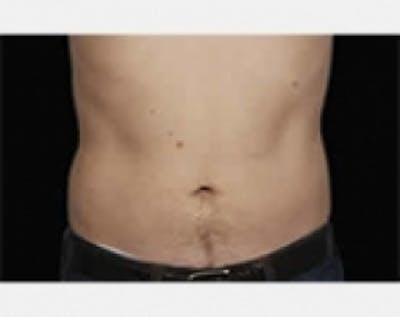 CoolSculpting Before & After Gallery - Patient 5883976 - Image 2