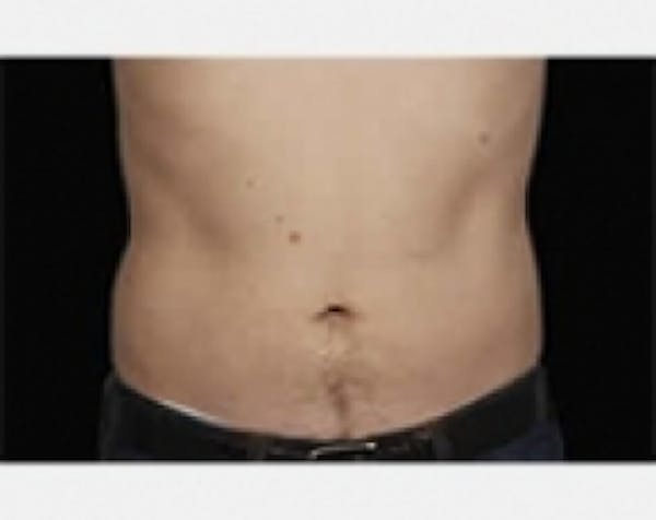 CoolSculpting Before & After Gallery - Patient 5883976 - Image 2